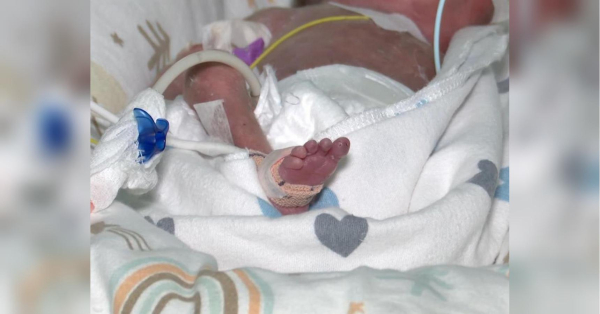 “Справжній витвір мистецтва”: у Луцьку виходили крихітку вагою лише 840 грамів при народженні